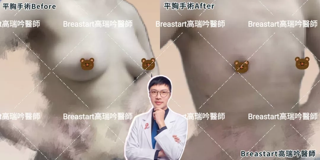 高雄隆乳 台南隆乳