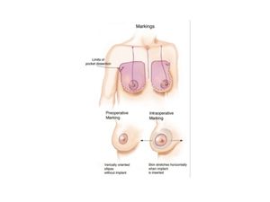 高瑞吟醫師 - 整形外科與乳房外科雙專科 乳房疾病、乳癌篩檢乳房超音波乳房攝影、乳房安可兒微創手術、乳癌術中放射線治療、乳房重建、自體脂肪隆乳、隆乳(蜜桃絨隆乳、柔滴隆乳、魔滴隆乳、女王波隆乳)、提乳手術、縮胸手術