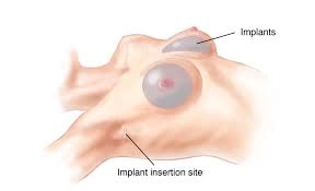 台南隆乳 高雄隆乳