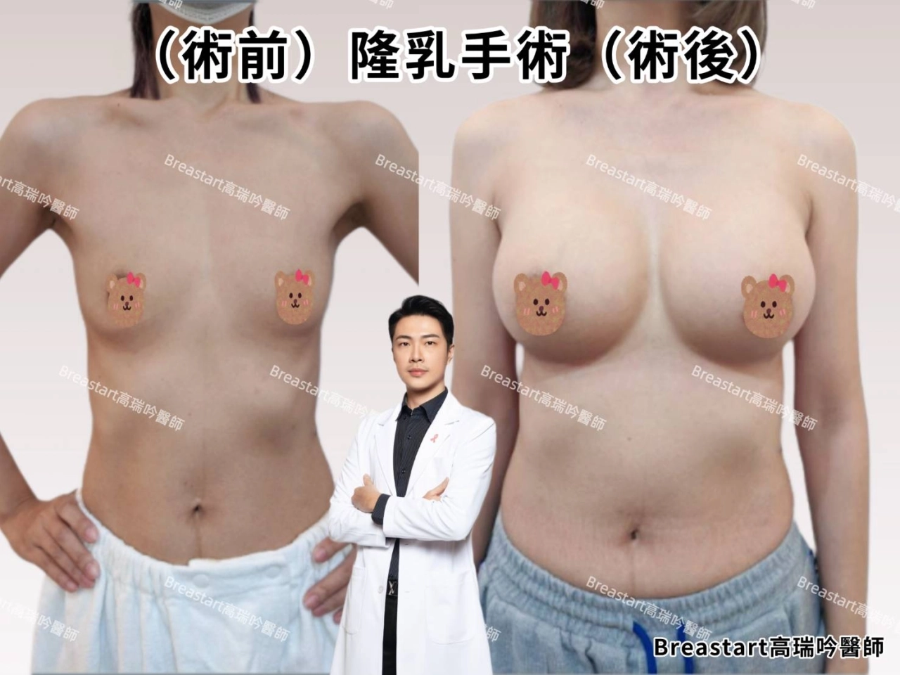 高雄隆乳推薦 台南隆乳推薦