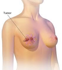 台南隆乳 高雄隆乳