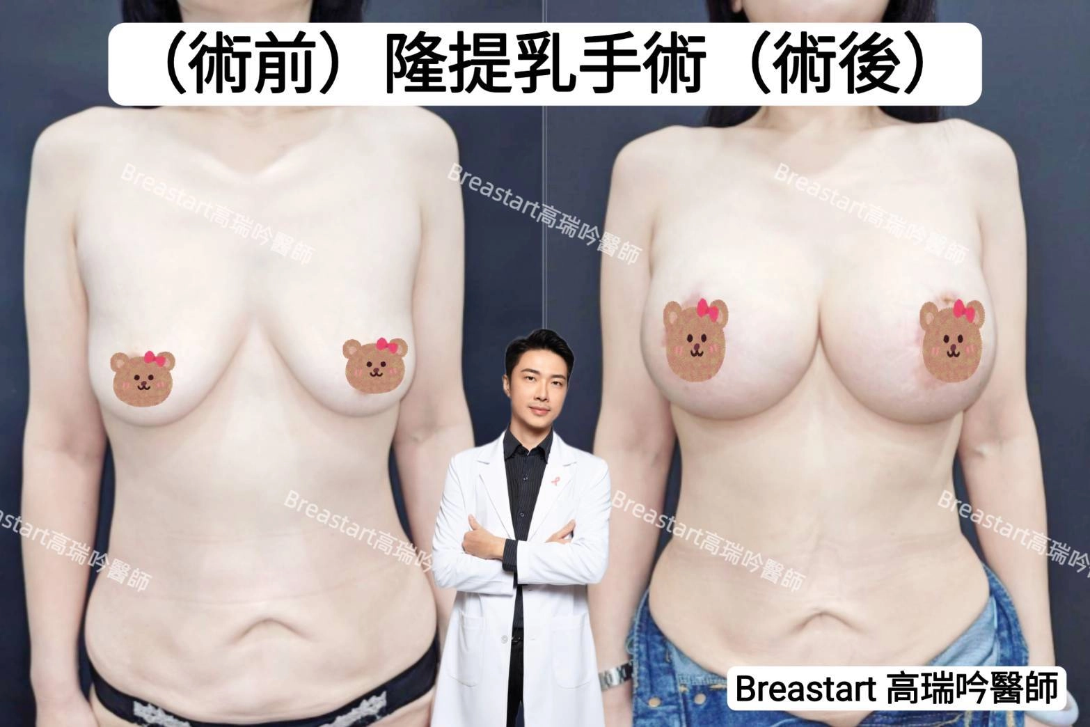 高雄隆乳推薦 台南隆乳推薦