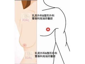 平胸手術的方式有哪些?半圓切口,圓形乳暈切口,棒棒糖式切口,一字型切口。