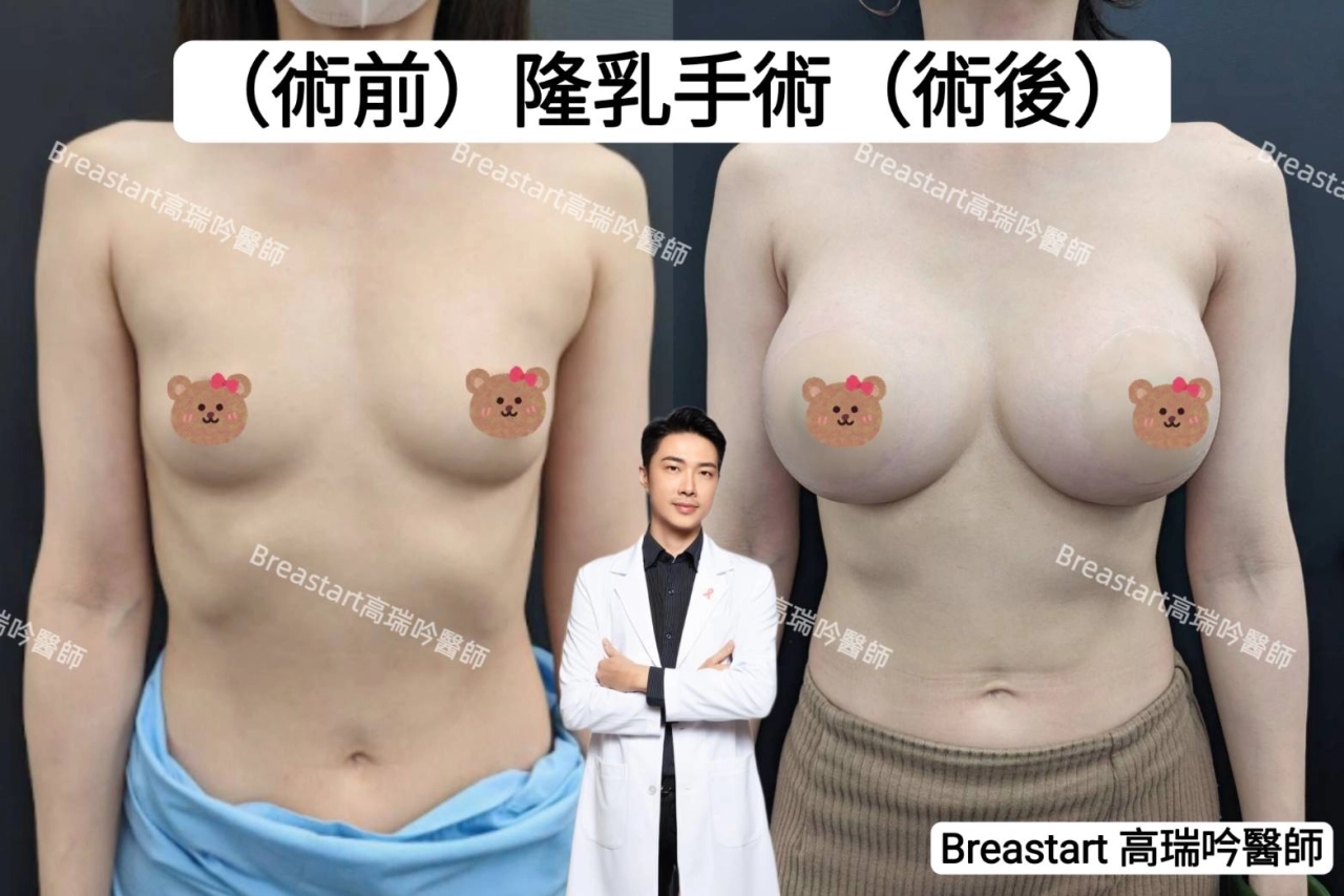 台南隆乳 高雄隆乳推薦